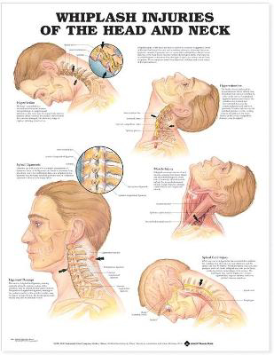 Picture of Whiplash Injuries of the Head and Neck Anatomical Chart