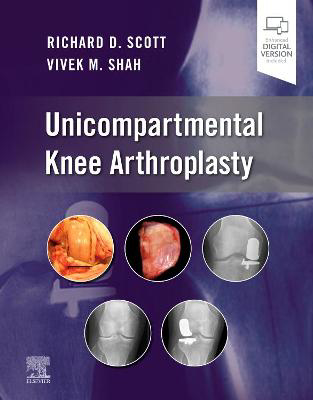 Picture of Unicompartmental Knee Arthroplasty