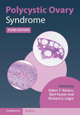 Picture of Polycystic Ovary Syndrome